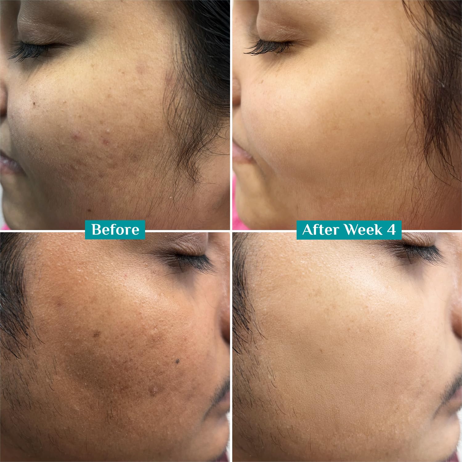 Pilgrim 10% Vitamin C Serum 30ml for Glowing Skin|With 5% Niacinamide, Hyaluronic & Glycolic Acid|Fades Dark Spots, Pigmentation|For All, Oily, Combination, Normal Skin |Beginner Friendly - Men, Women