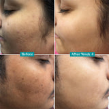 Pilgrim 10% Vitamin C Serum 30ml for Glowing Skin|With 5% Niacinamide, Hyaluronic & Glycolic Acid|Fades Dark Spots, Pigmentation|For All, Oily, Combination, Normal Skin |Beginner Friendly - Men, Women